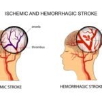 Mengenal Stroke Iskemik